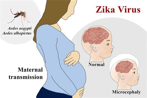 zika virus schwangerschaft
